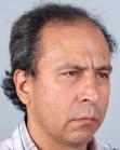 Before Hair Transplant&nbsp;Front